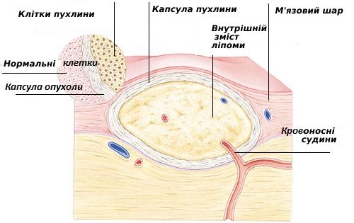 lechenie_dobrokachestvennih_opuholei_myagkih_tkanei