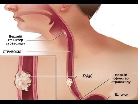 Laparoscopia